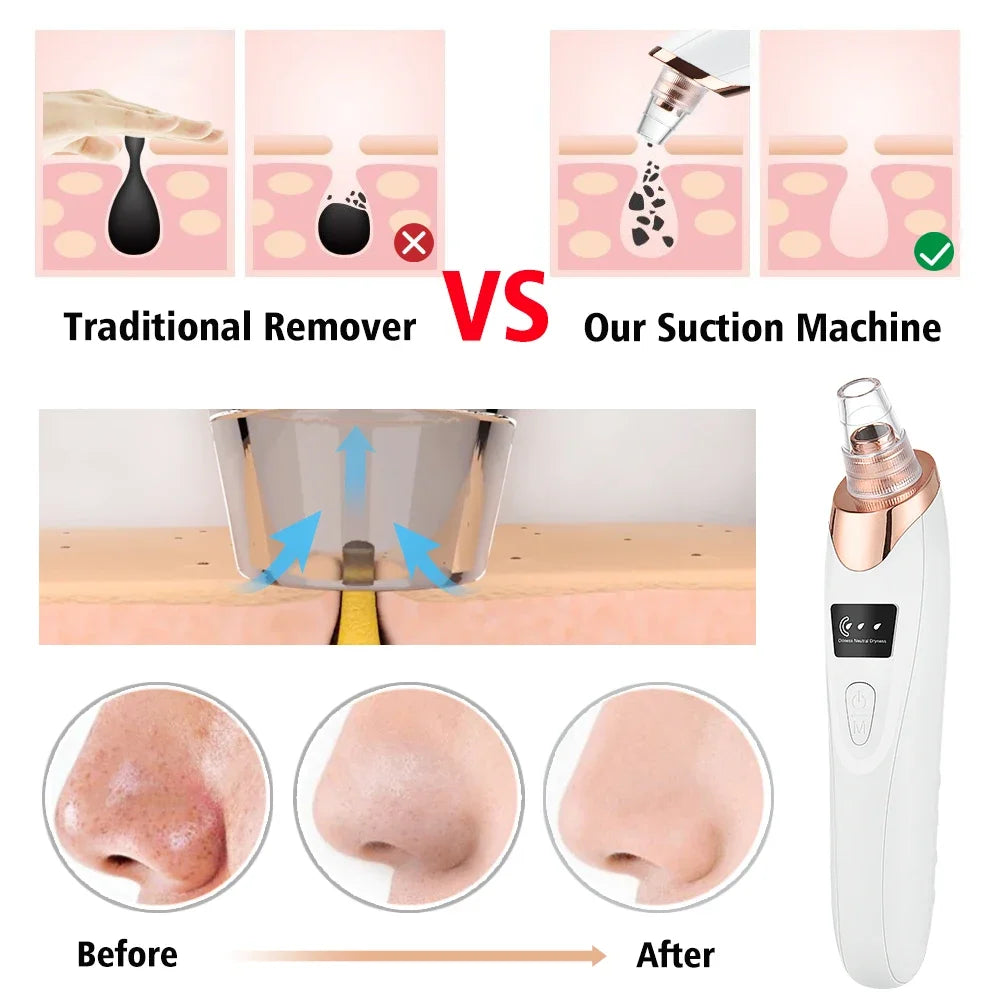 Removedor eléctrico de espinillas, limpiador al vacío para acné, eliminación de manchas negras, limpieza Facial profunda de poros, máquina limpiadora de poros, herramientas para el cuidado de la piel