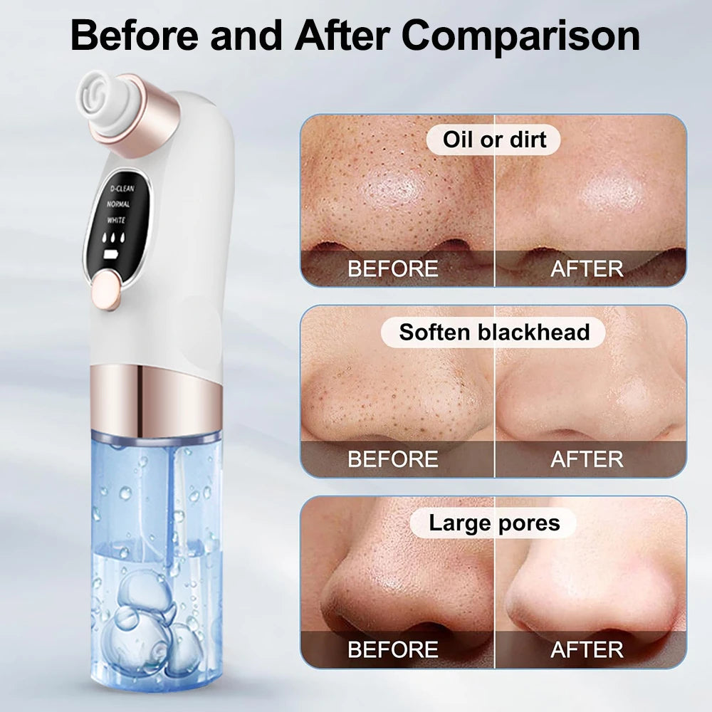 Removedor de espinillas, aspirador de poros, instrumento de limpieza multifuncional, máquina de limpieza facial con pequeñas burbujas, dispositivo de belleza