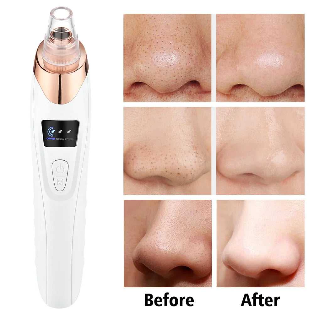Removedor eléctrico de espinillas, limpiador al vacío para acné, eliminación de manchas negras, limpieza Facial profunda de poros, máquina limpiadora de poros, herramientas para el cuidado de la piel