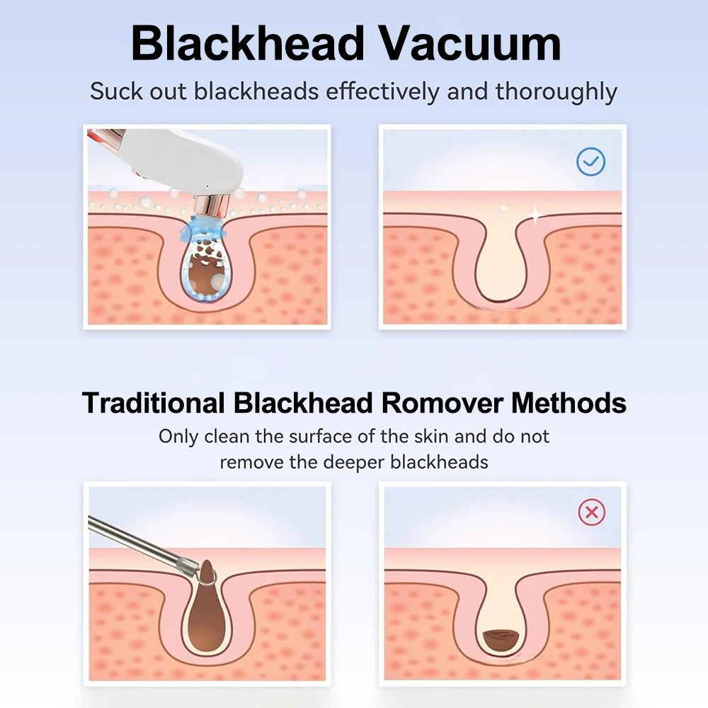 Removedor de espinillas, aspirador de poros, instrumento de limpieza multifuncional, máquina de limpieza facial con pequeñas burbujas, dispositivo de belleza